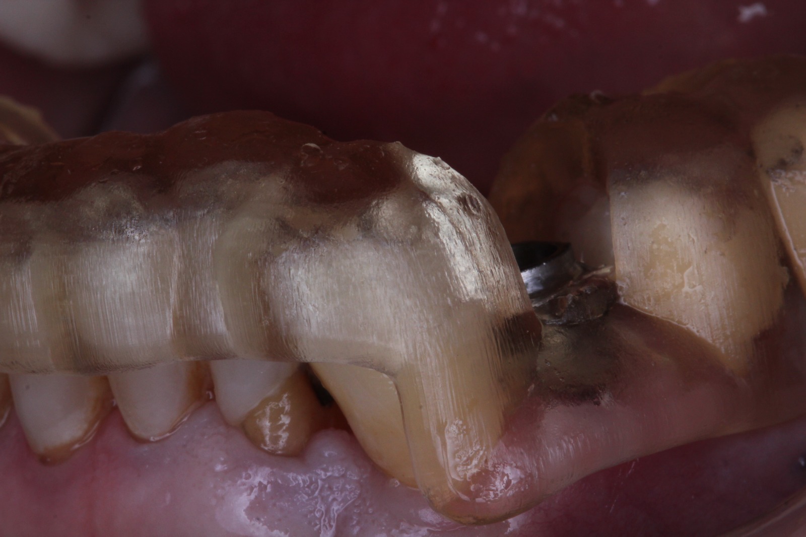 Foto de previa de cigugia giada parcial. Imagen de Clínica Dental Proboca. Clínica Dental en Santoña. Solución para Odontología conservadora, implantología, limpiezas dentales sin dolor,ortodoncia (Ortodoncia brackets y ortodoncia invisible), carillas inyectadas, periodoncia, DSD (Digital Smile Design), Carillas de Porcelana, Tratamientos Multidisciplinares complejos. Soluciones para problemas dentales en Santoña, tecnología a tu disposición.