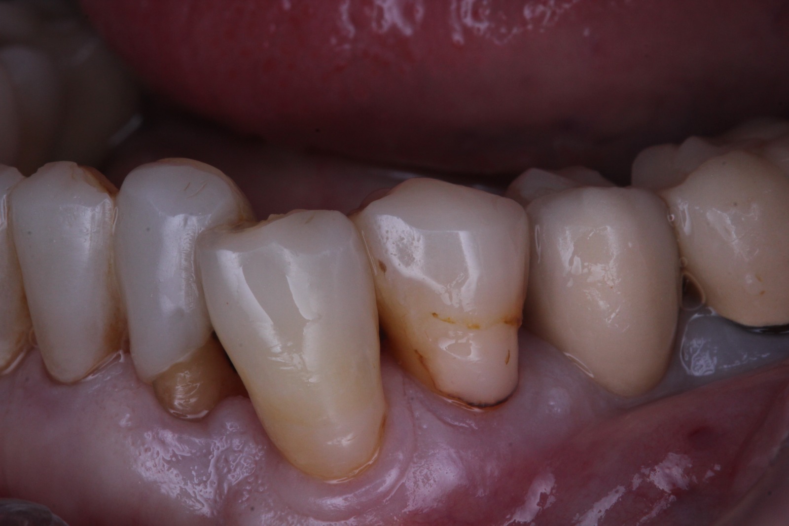 Foto de previa de cigugia giada parcial. Imagen de Clínica Dental Proboca. Clínica Dental en Santoña. Solución para Odontología conservadora, implantología, limpiezas dentales sin dolor,ortodoncia (Ortodoncia brackets y ortodoncia invisible), carillas inyectadas, periodoncia, DSD (Digital Smile Design), Carillas de Porcelana, Tratamientos Multidisciplinares complejos. Soluciones para problemas dentales en Santoña, tecnología a tu disposición.