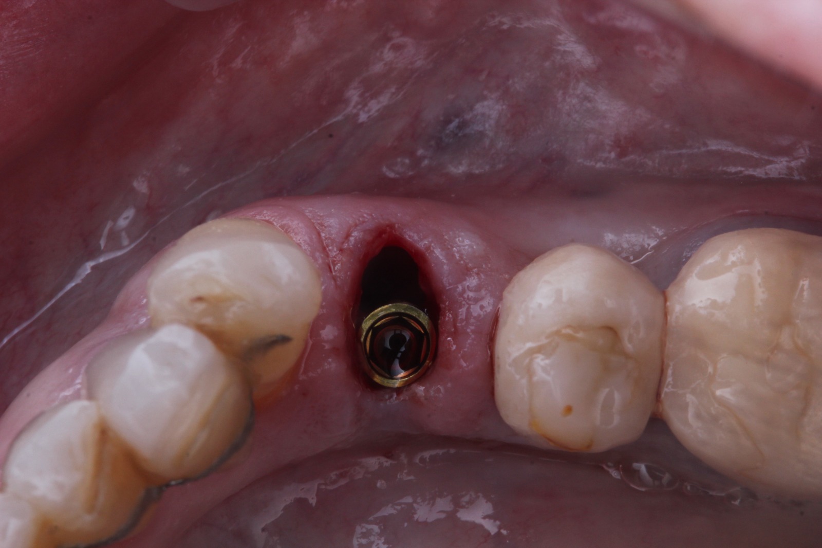 Foto de previa de cirugía guiada parcial. Imagen de Clínica Dental Proboca. Clínica Dental en Santoña. Solución para Odontología conservadora, implantología, limpiezas dentales sin dolor,ortodoncia (Ortodoncia brackets y ortodoncia invisible), carillas inyectadas, periodoncia, DSD (Digital Smile Design), Carillas de Porcelana, Tratamientos Multidisciplinares complejos. Soluciones para problemas dentales en Santoña, tecnología a tu disposición.