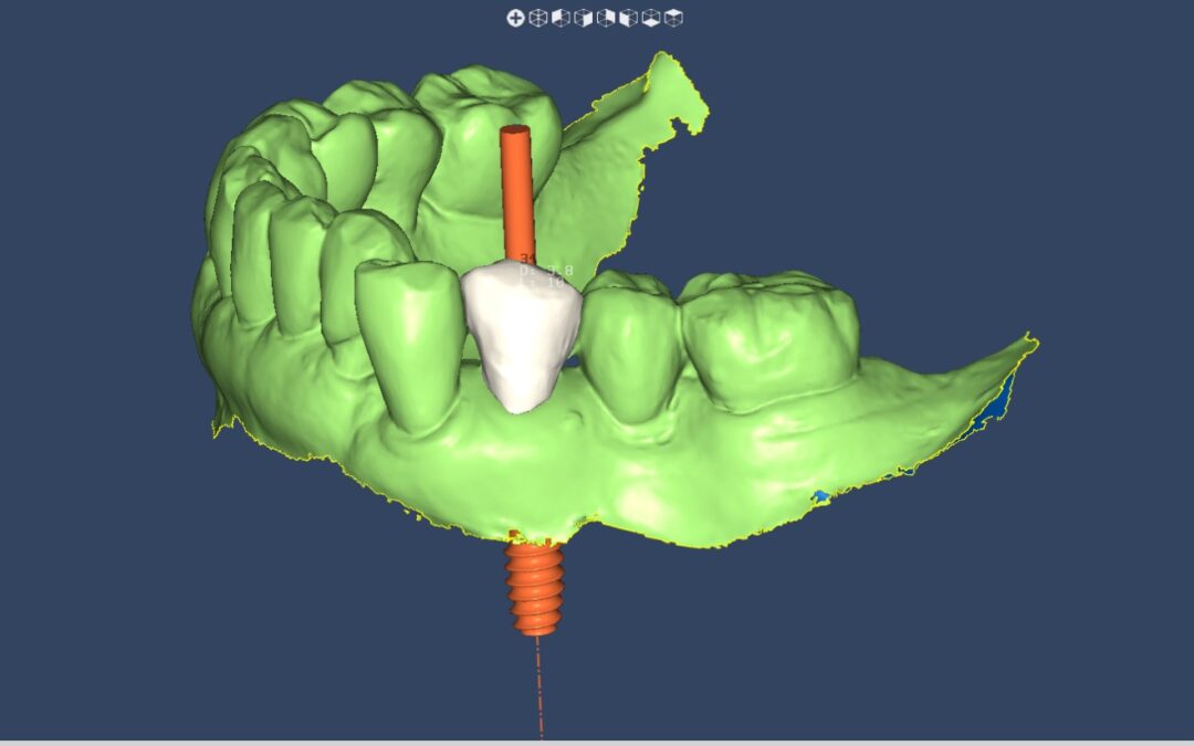 Foto de previa de cigugia giada parcial. Imagen de Clínica Dental Proboca. Clínica Dental en Santoña. Solución para Odontología conservadora, implantología, limpiezas dentales sin dolor,ortodoncia (Ortodoncia brackets y ortodoncia invisible), carillas inyectadas, periodoncia, DSD (Digital Smile Design), Carillas de Porcelana, Tratamientos Multidisciplinares complejos. Soluciones para problemas dentales en Santoña, tecnología a tu disposición.