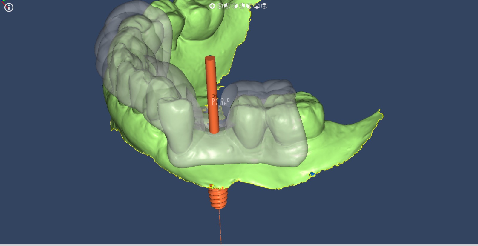 Foto de previa de cigugia giada parcial. Imagen de Clínica Dental Proboca. Clínica Dental en Santoña. Solución para Odontología conservadora, implantología, limpiezas dentales sin dolor,ortodoncia (Ortodoncia brackets y ortodoncia invisible), carillas inyectadas, periodoncia, DSD (Digital Smile Design), Carillas de Porcelana, Tratamientos Multidisciplinares complejos. Soluciones para problemas dentales en Santoña, tecnología a tu disposición.