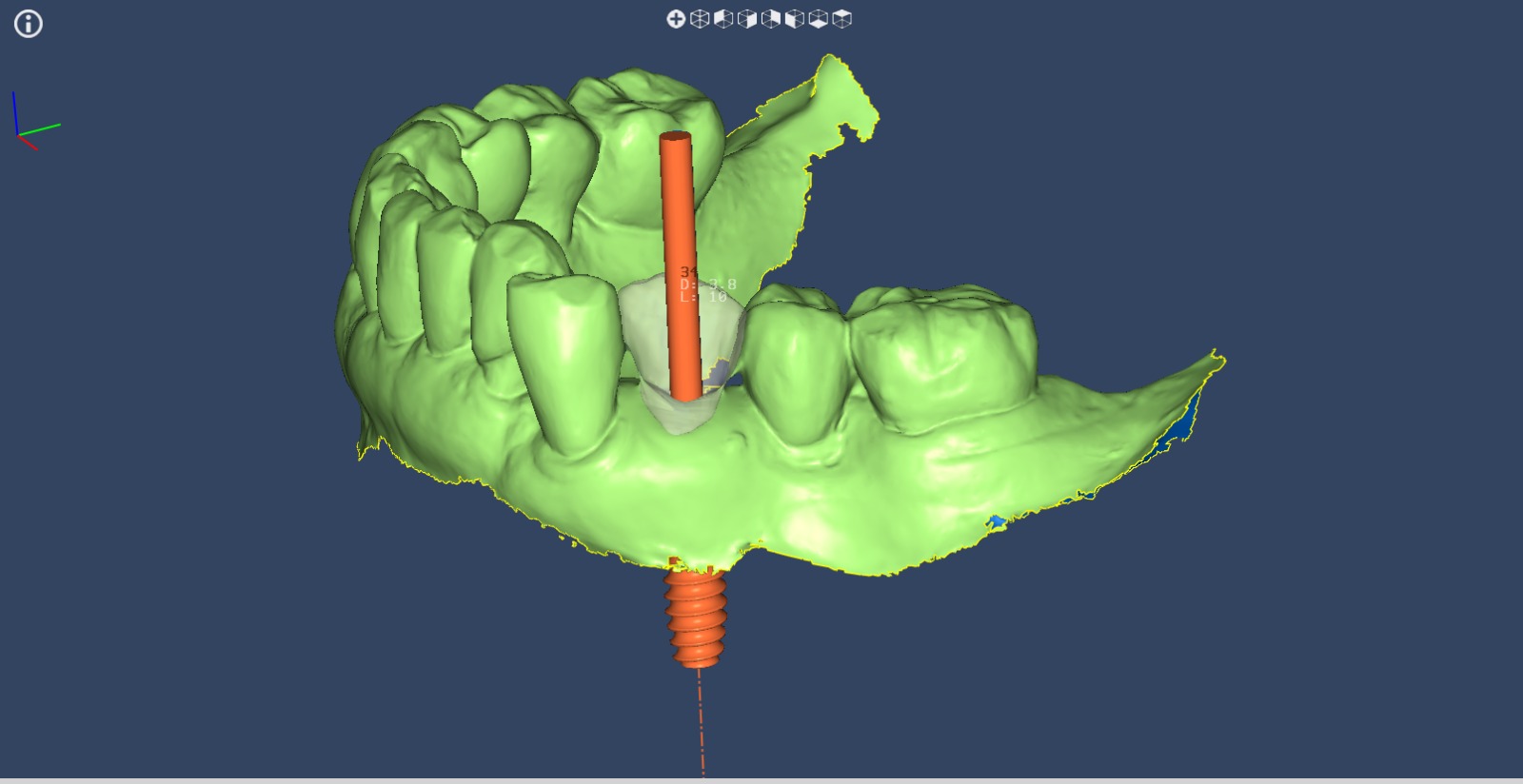 Foto de previa de cigugia giada parcial. Imagen de Clínica Dental Proboca. Clínica Dental en Santoña. Solución para Odontología conservadora, implantología, limpiezas dentales sin dolor,ortodoncia (Ortodoncia brackets y ortodoncia invisible), carillas inyectadas, periodoncia, DSD (Digital Smile Design), Carillas de Porcelana, Tratamientos Multidisciplinares complejos. Soluciones para problemas dentales en Santoña, tecnología a tu disposición.