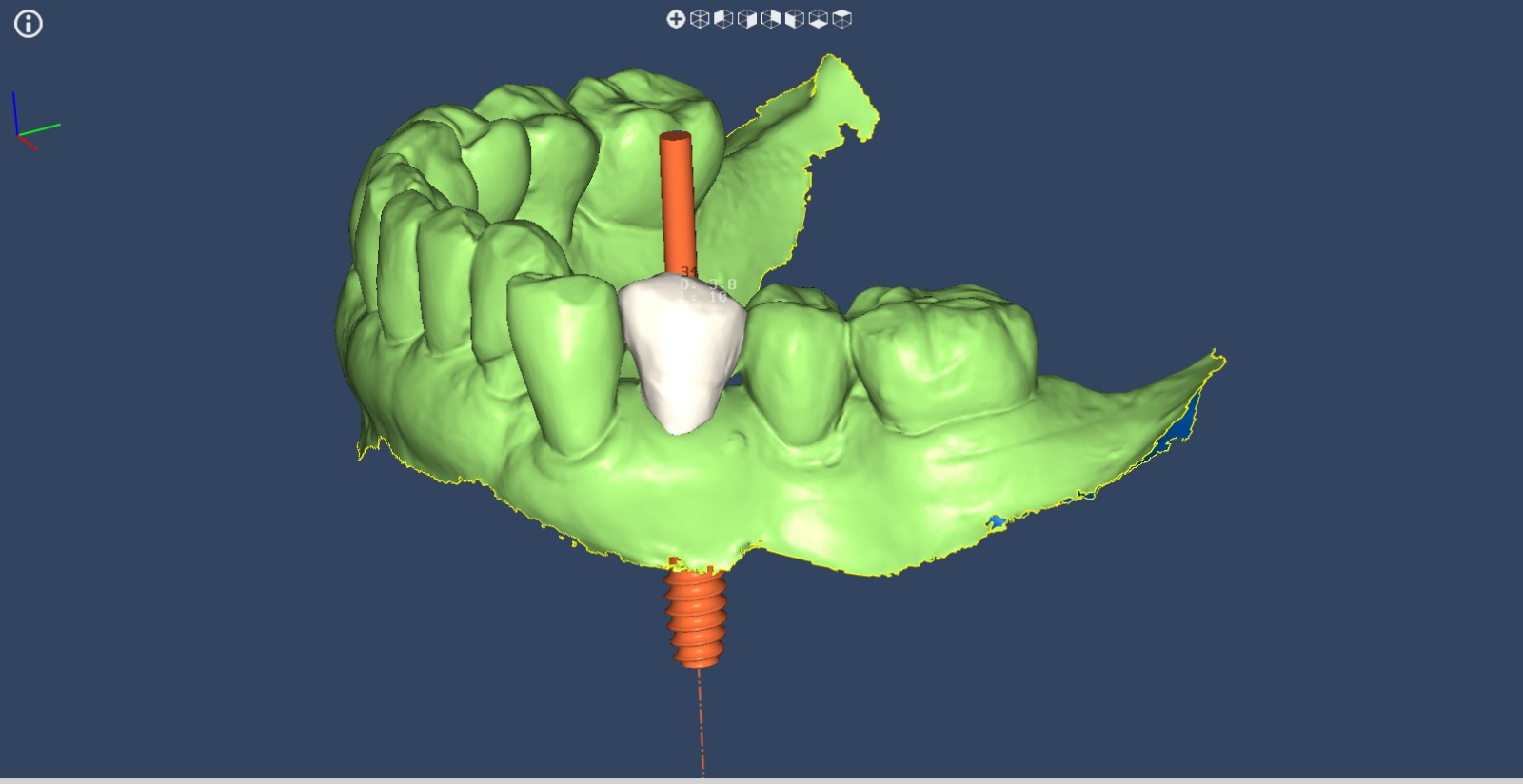 Foto de previa de cigugia giada parcial. Imagen de Clínica Dental Proboca. Clínica Dental en Santoña. Solución para Odontología conservadora, implantología, limpiezas dentales sin dolor,ortodoncia (Ortodoncia brackets y ortodoncia invisible), carillas inyectadas, periodoncia, DSD (Digital Smile Design), Carillas de Porcelana, Tratamientos Multidisciplinares complejos. Soluciones para problemas dentales en Santoña, tecnología a tu disposición.