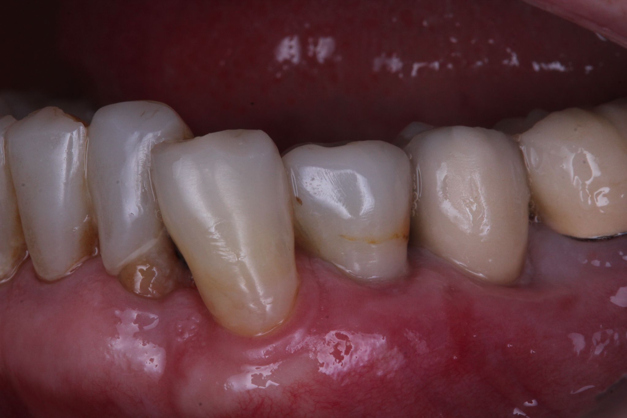 Foto de previa de cigugia giada parcial. Imagen de Clínica Dental Proboca. Clínica Dental en Santoña. Solución para Odontología conservadora, implantología, limpiezas dentales sin dolor,ortodoncia (Ortodoncia brackets y ortodoncia invisible), carillas inyectadas, periodoncia, DSD (Digital Smile Design), Carillas de Porcelana, Tratamientos Multidisciplinares complejos. Soluciones para problemas dentales en Santoña, tecnología a tu disposición.